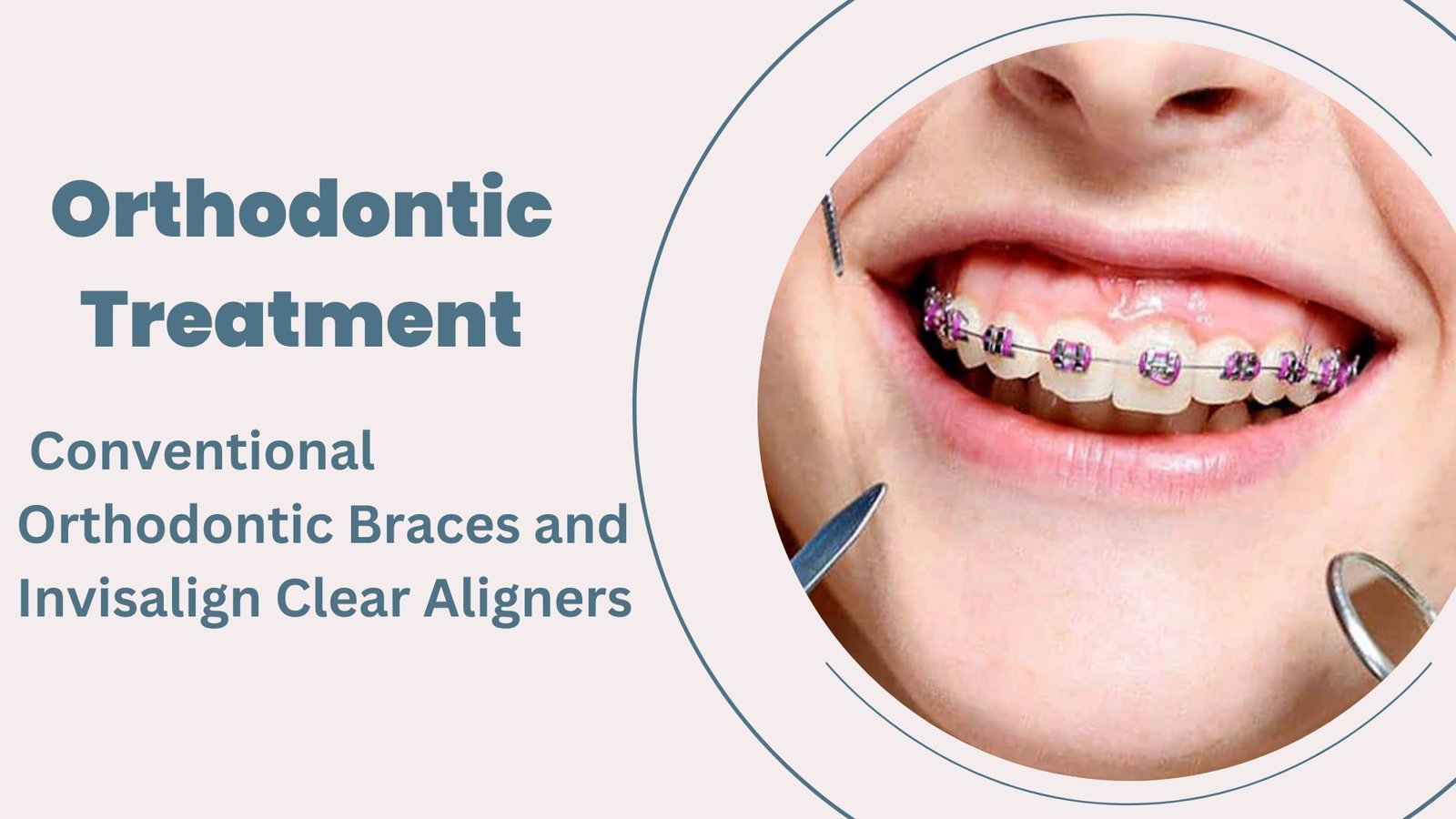 Aligners and Orthodontic Correction