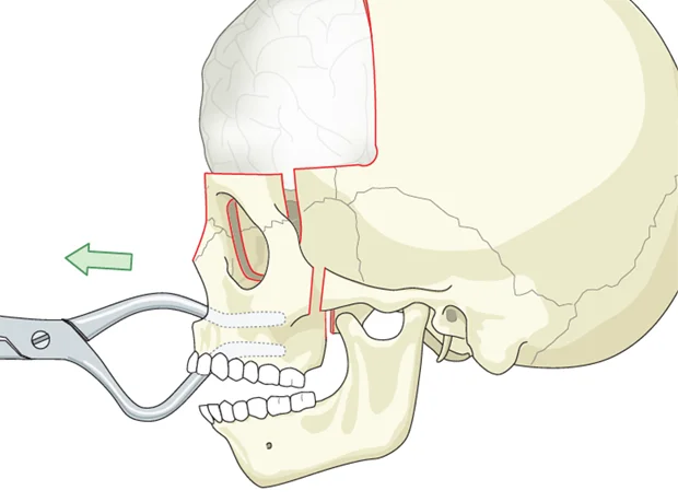 Disimpactions and facial surgeries