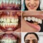 veneers