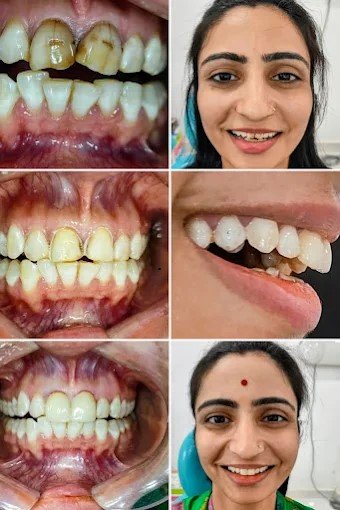 veneers